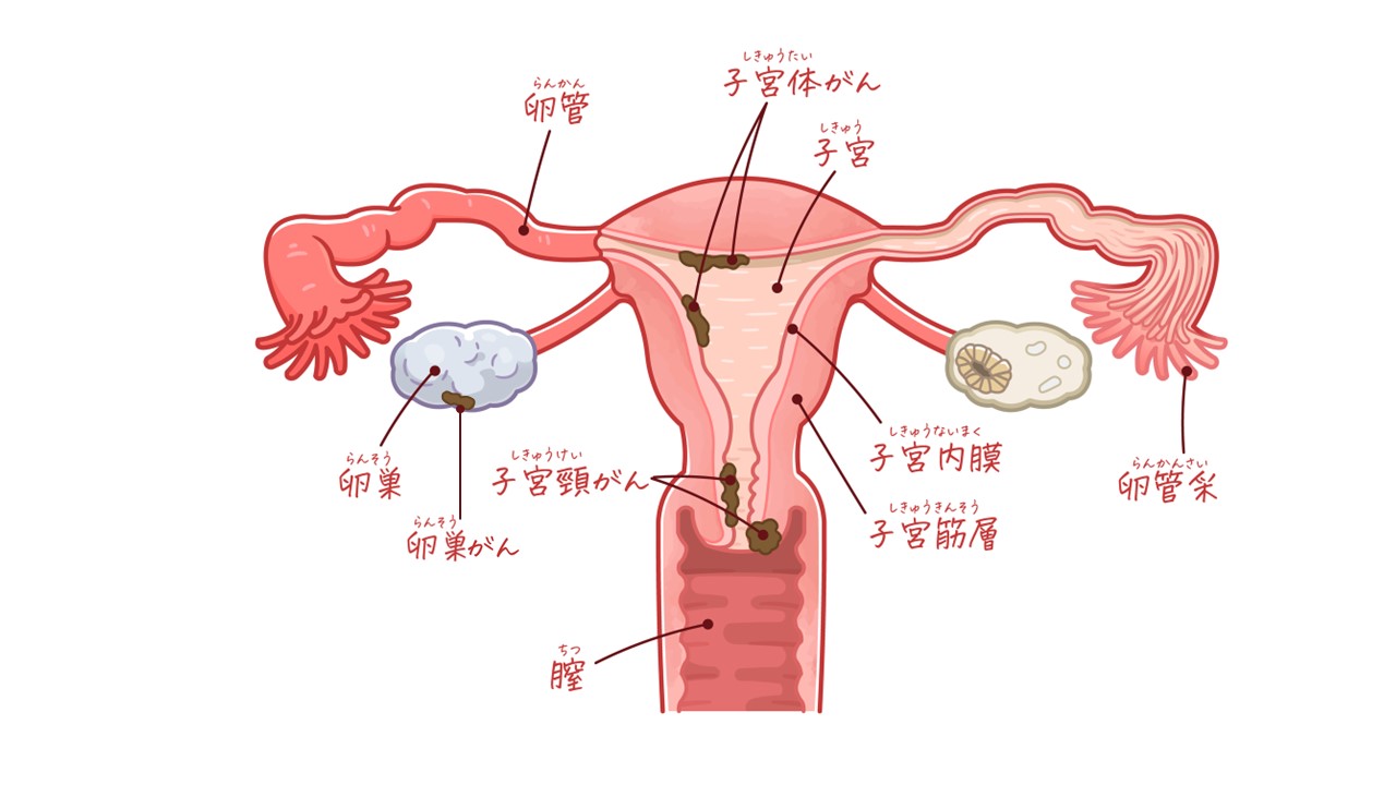 図3　子宮頸がん
